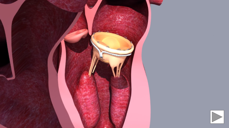 Animation of the Saturn TMVR System Trans-septal Procedure